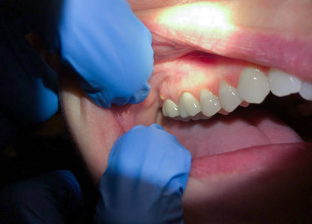 Best Lost Filling or Crown Replacement in South El Monte, CA