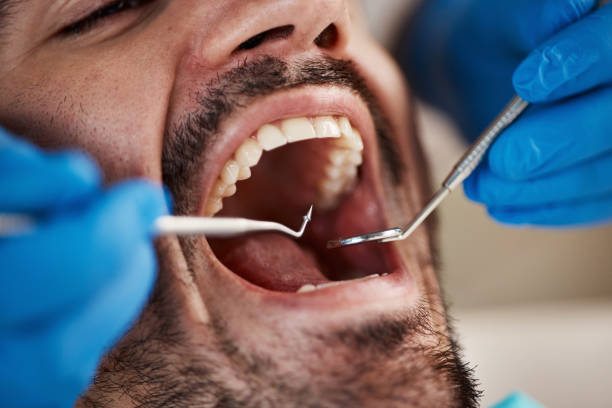 Best Knocked-Out Tooth (Avulsed Tooth) Treatment in South El Monte, CA